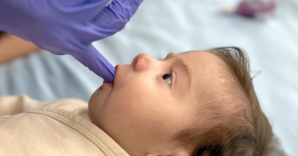 Frenectomy. Doctor assessing infant